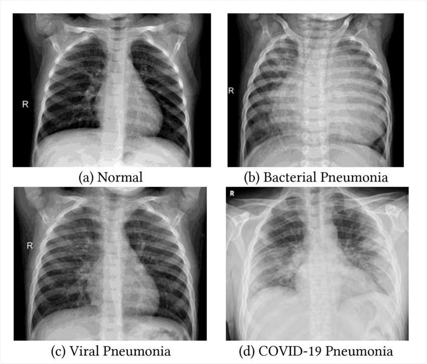 Medical diagnosis using Deep Learning covid