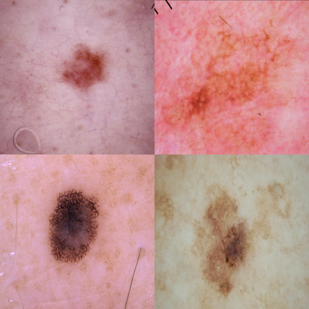 Skin cancer dataset|Binary Classification