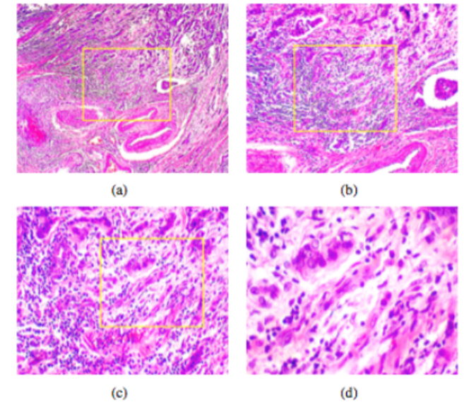 breast cancer classification dataset